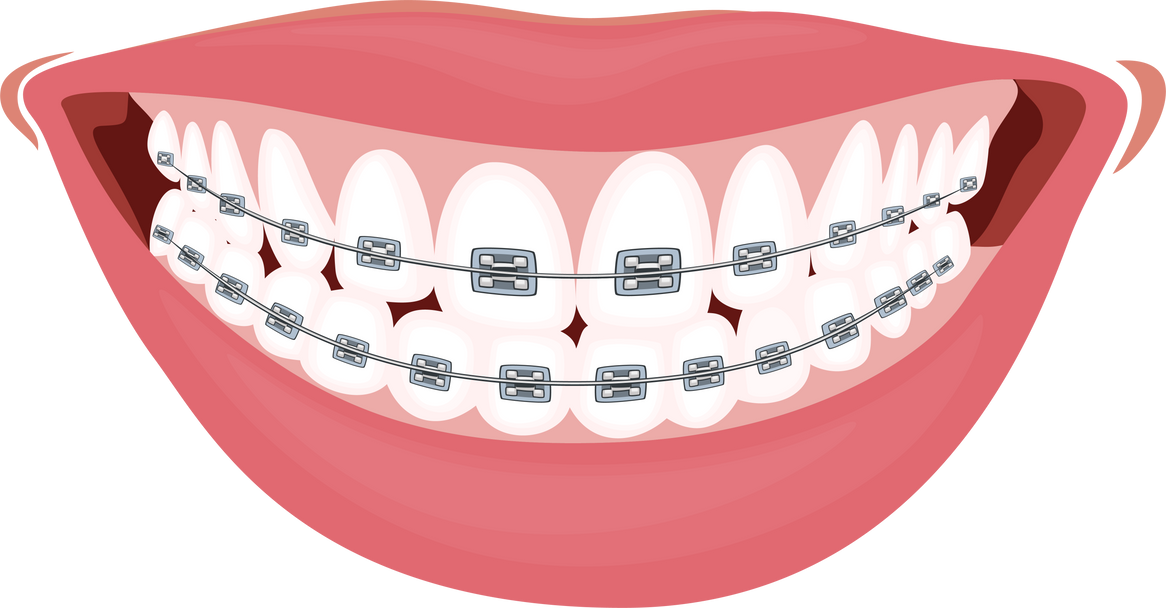 Female Smile With dental braces on teeth illustration