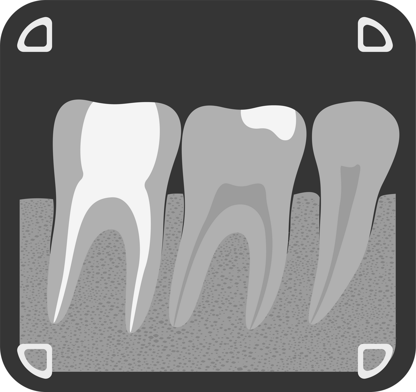 Tooth -ray illustration, Dental -ray