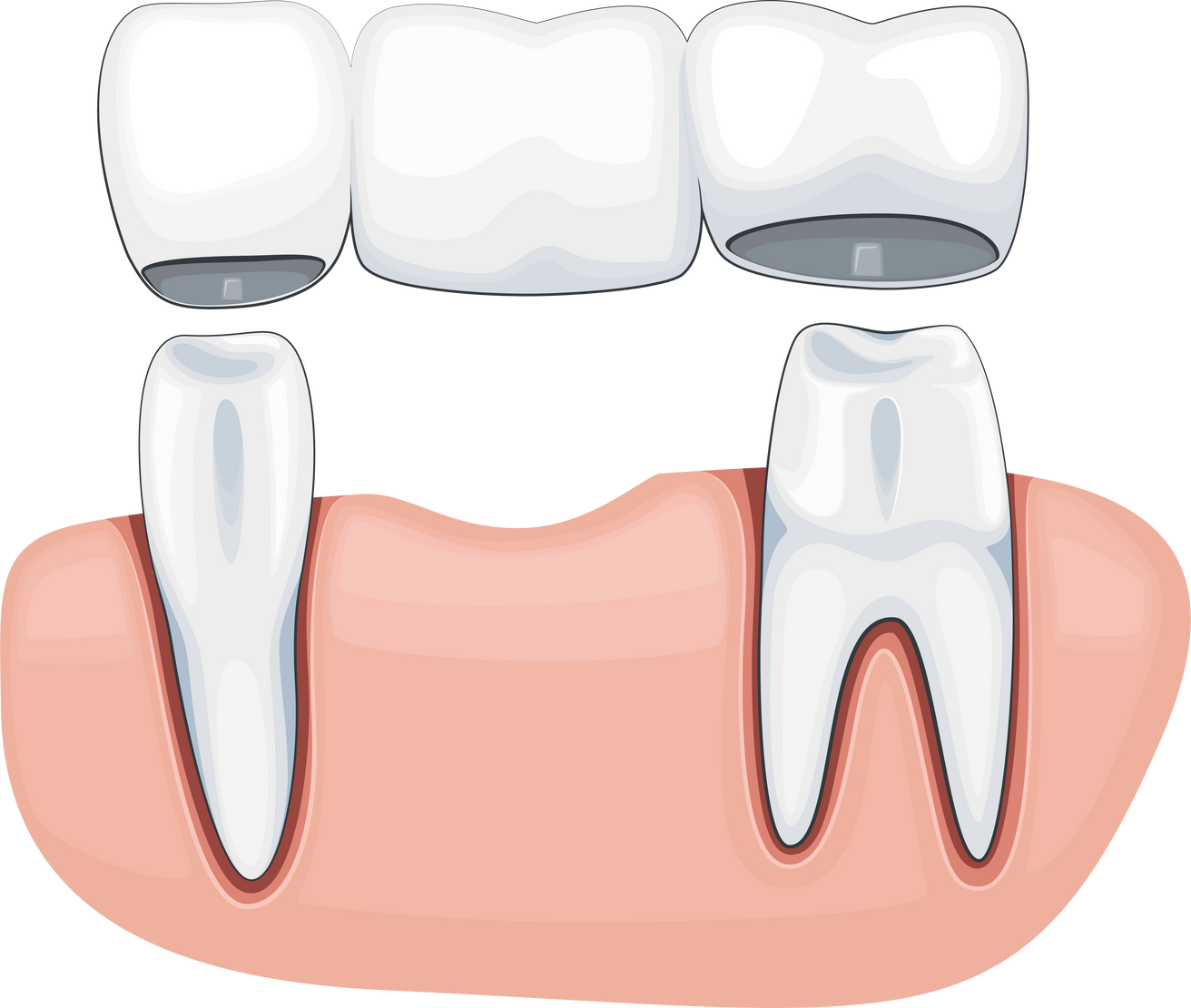 Tooth Crown Illustration, Dental Supplies